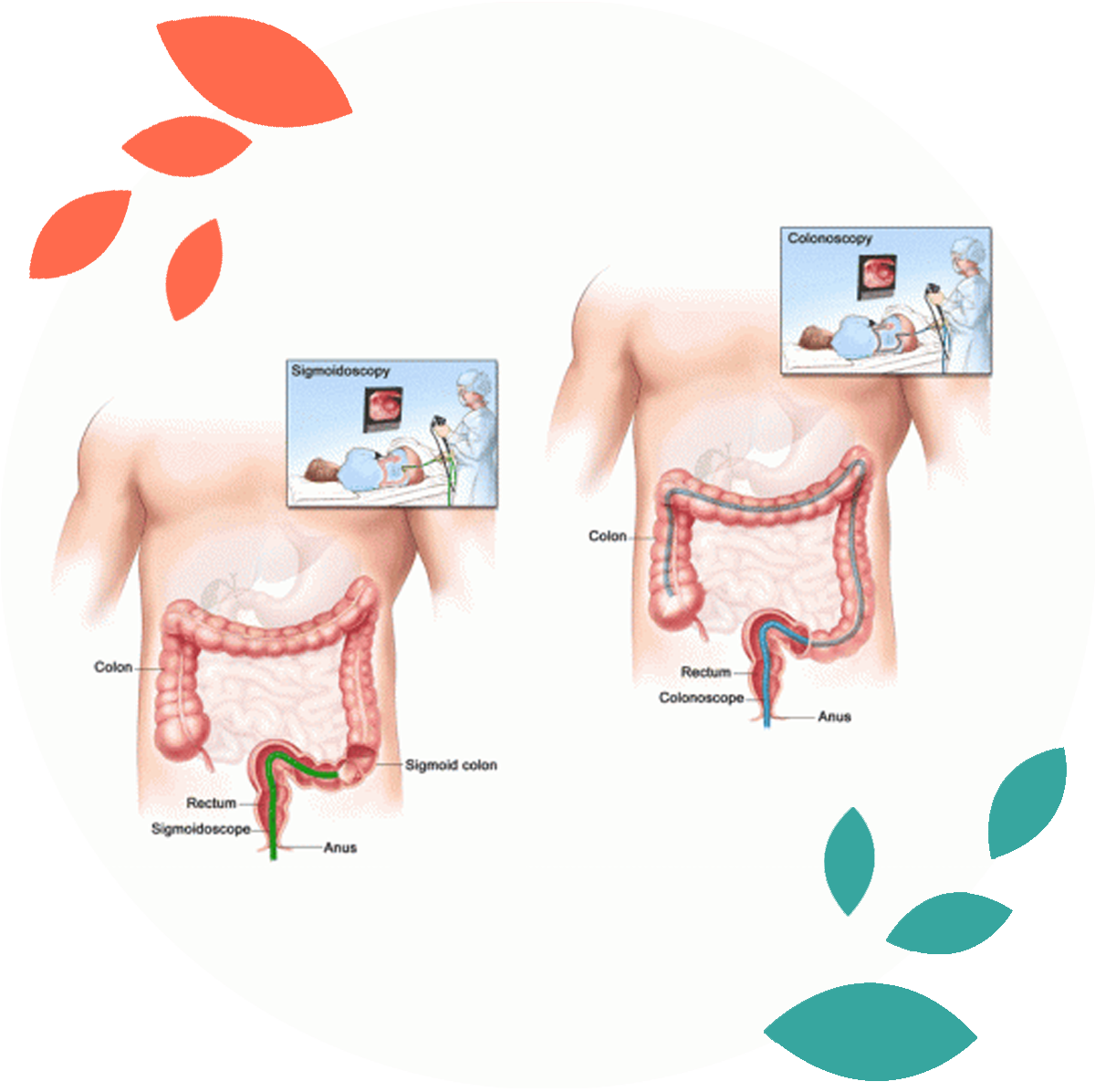 screening for colon disease surgery in delhi noida
