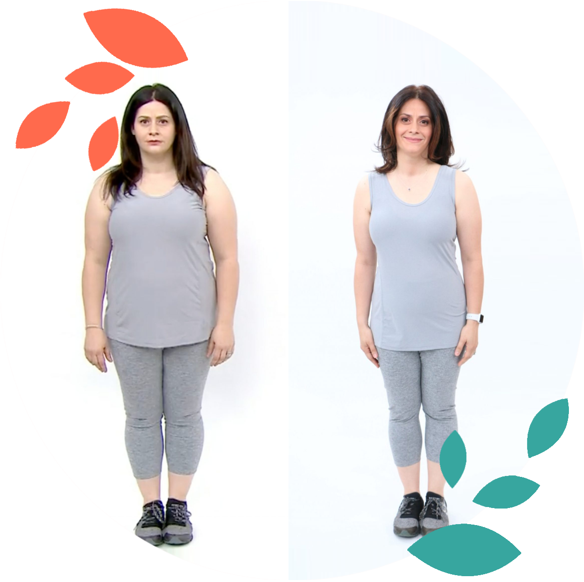 sleeve gastrectomy surgery in delhi noida